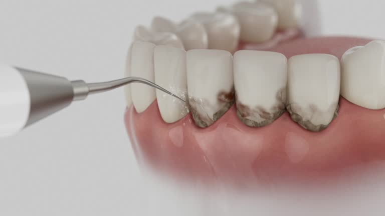 Trusted Wisdom Tooth Removal service in Bolingbrook, IL - Dentist Open Now